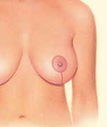 body contouring breast lift