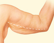 body contouring arm lift