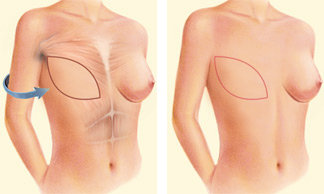 Choosing To Go Flat Instead of Breast Reconstruction - OWise US