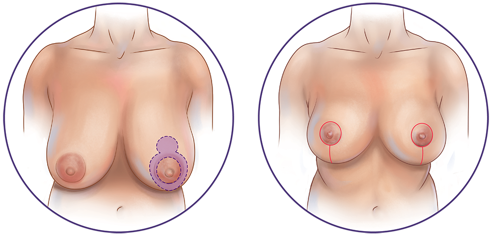 Breast Reduction Procedure Steps  American Society of Plastic Surgeons