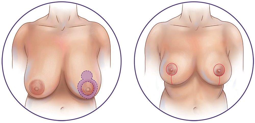 Breast Reduction Procedure Steps