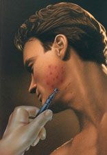 dermabrasion
