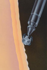 dermabrasion