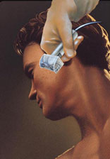 dermabrasion