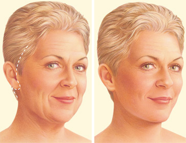 Facelift Procedure Steps  American Society of Plastic Surgeons