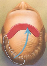 Hair Transplant Procedure Steps | American Society of Plastic Surgeons