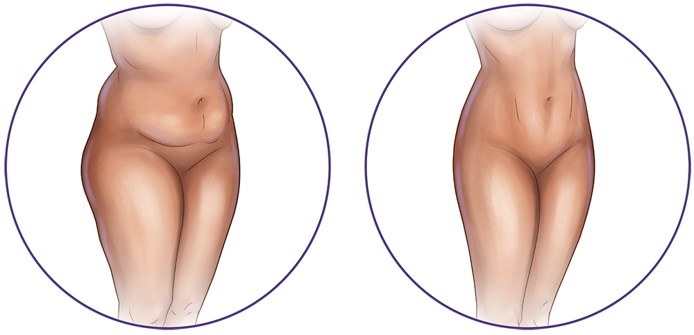 Liposuction abdomen and legs