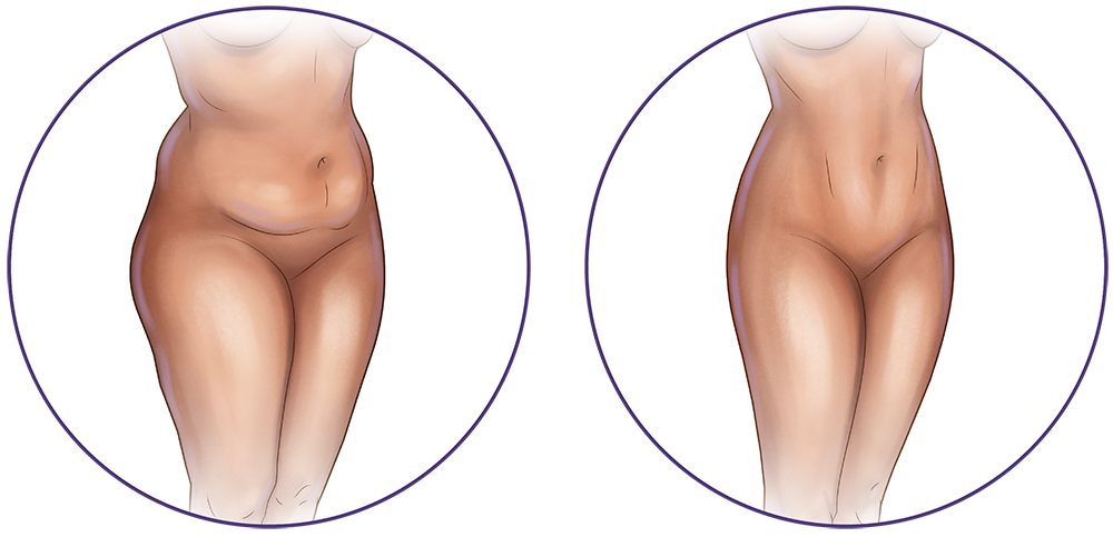 Liposuction Austin