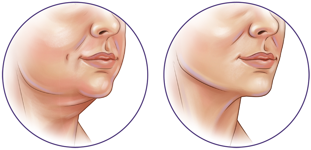 Liposuction face and neck