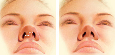 Rhinoplasty Surgery