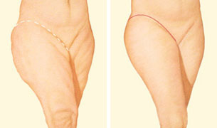 Outer thigh lift incision