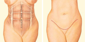 Tummy Tuck