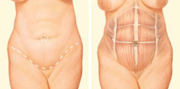 Tummy Tuck (Abdominoplasty), Main Line Plastic Surgery