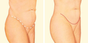 Tummy tuck side before and after