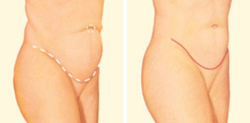 How Long Does a Tummy Tuck Last?  Parker Center for Plastic Surgery