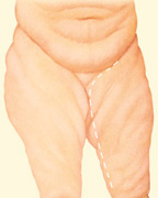 body contouring