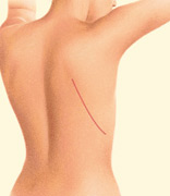 Breast Reconstruction Latissimus Dorsi Flap