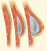 Placement of a Breast Implant