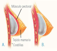 inserción y colocación del implante