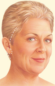 Estiramiento facial tradicional 