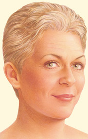 Estiramiento facial tradicional 