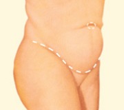 Tummy Tuck, Lower Incision Outline