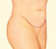 Tummy Tuck, Lower Incision