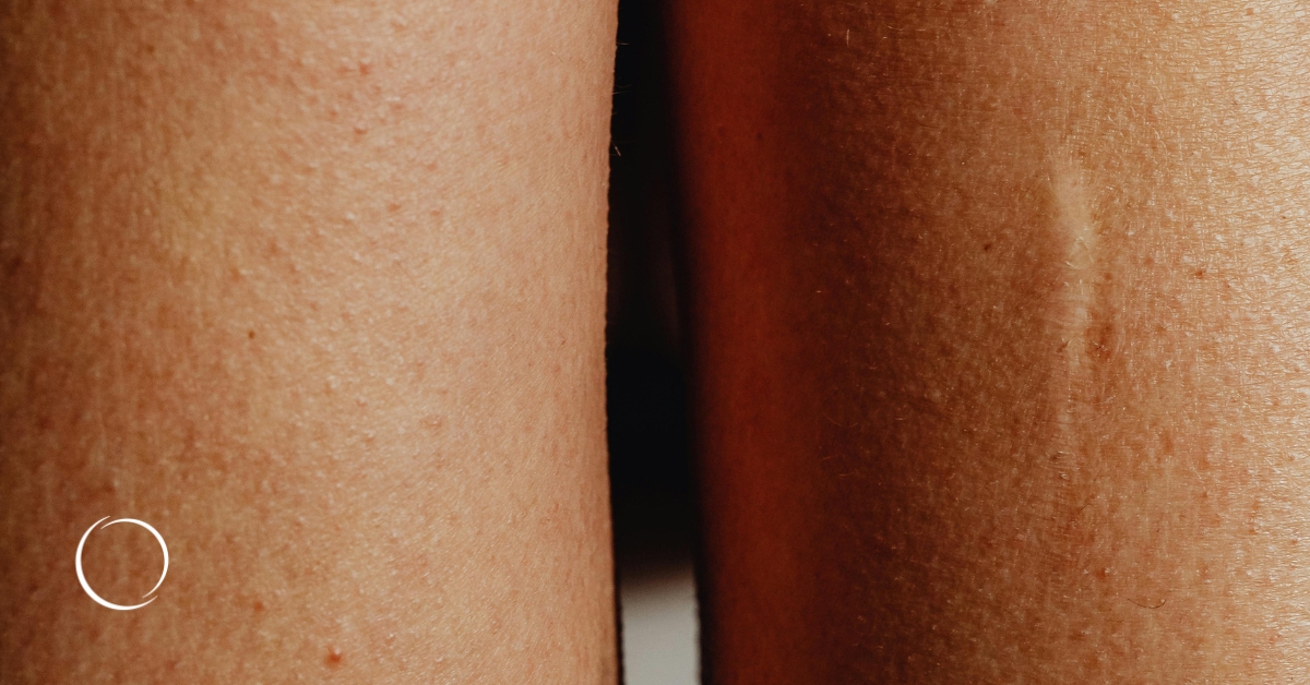 More than a wrinkle reducer, botulinum toxin type A may also improve scars