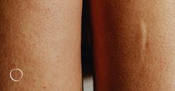 More than a wrinkle reducer, botulinum toxin type A may also improve scars