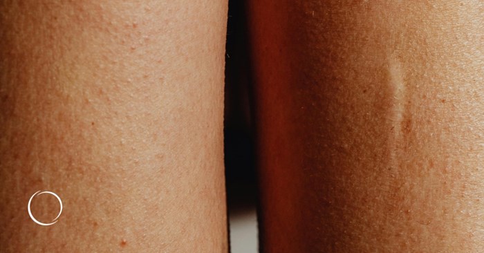 More than a wrinkle reducer, botulinum toxin type A may also improve scars
