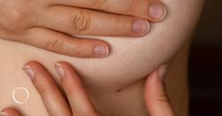Fat transfer may offer another option for breast reconstruction