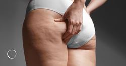 What is Ozempic butt? Understanding this weight loss side effect and available treatment options