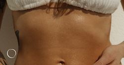 The reverse tummy tuck: What patients need to know
