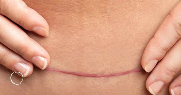 What to expect as a scar heals following plastic surgery