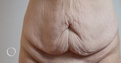 Lifts after weight loss: Skin excision surgery after the weight comes off