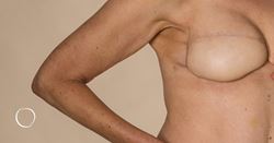 Tissue-based breast reconstruction: Using your own tissue to restore your breasts