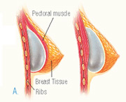 submuscular and subglandular breast implant placement