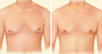 male breast reduction