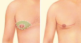 male breast reduction