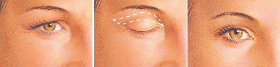 eyelid surgery upper eyelid incision
