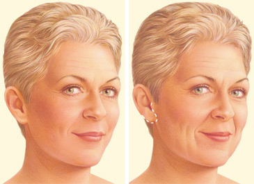 Facelift limited incision Facelift limited incision