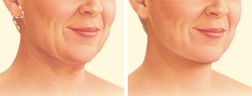 Facelift neck lift incision