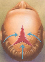 hair transplant