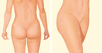 Liposuction rear and side after