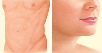 Liposuction front and face after