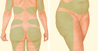 Flank, Back, and Waist Liposuction