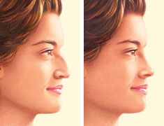 Rhinoplasty before and after