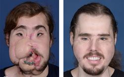 Planning the key to highly complicated – and successful – face transplant