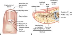 Consult Corner: Laceration through the nail bed
