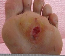 Consult Corner: Diabetic foot wounds
